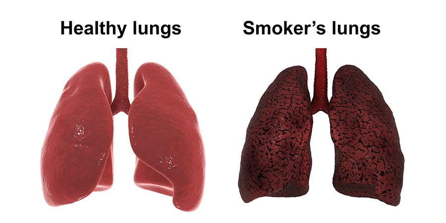 smokers vs nonsmokers lungs